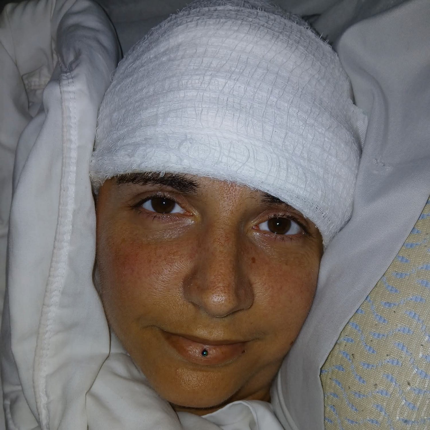 Audrey wearing a white headband post op with a neutral expression, surrounded by white fabric.